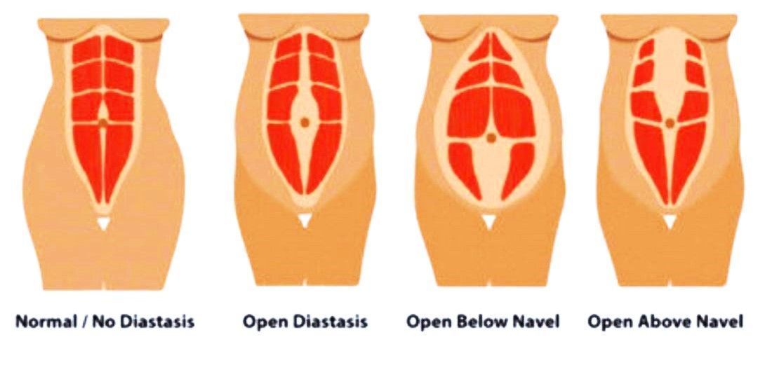 Struggling with ab separation after giving birth? Discover the best diastasis recti exercises to fix diastasis recti and restore your core strength postpartum.
