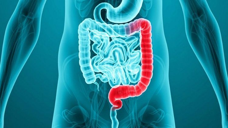 Ulcerative colitis is a chronic inflammatory bowel disease that requires ongoing management
