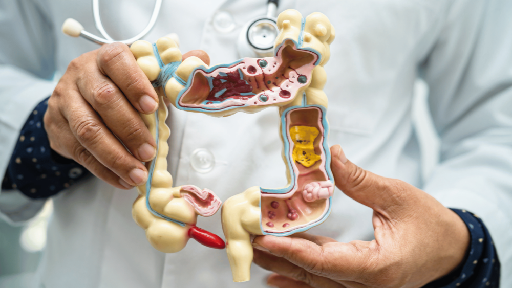 Inflammatory Bowel Disease (IBD) encompasses a group of chronic conditions