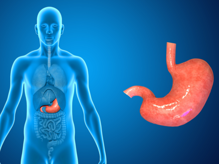Gastroparesis is a gastrointestinal disorder characterized by delayed stomach emptying