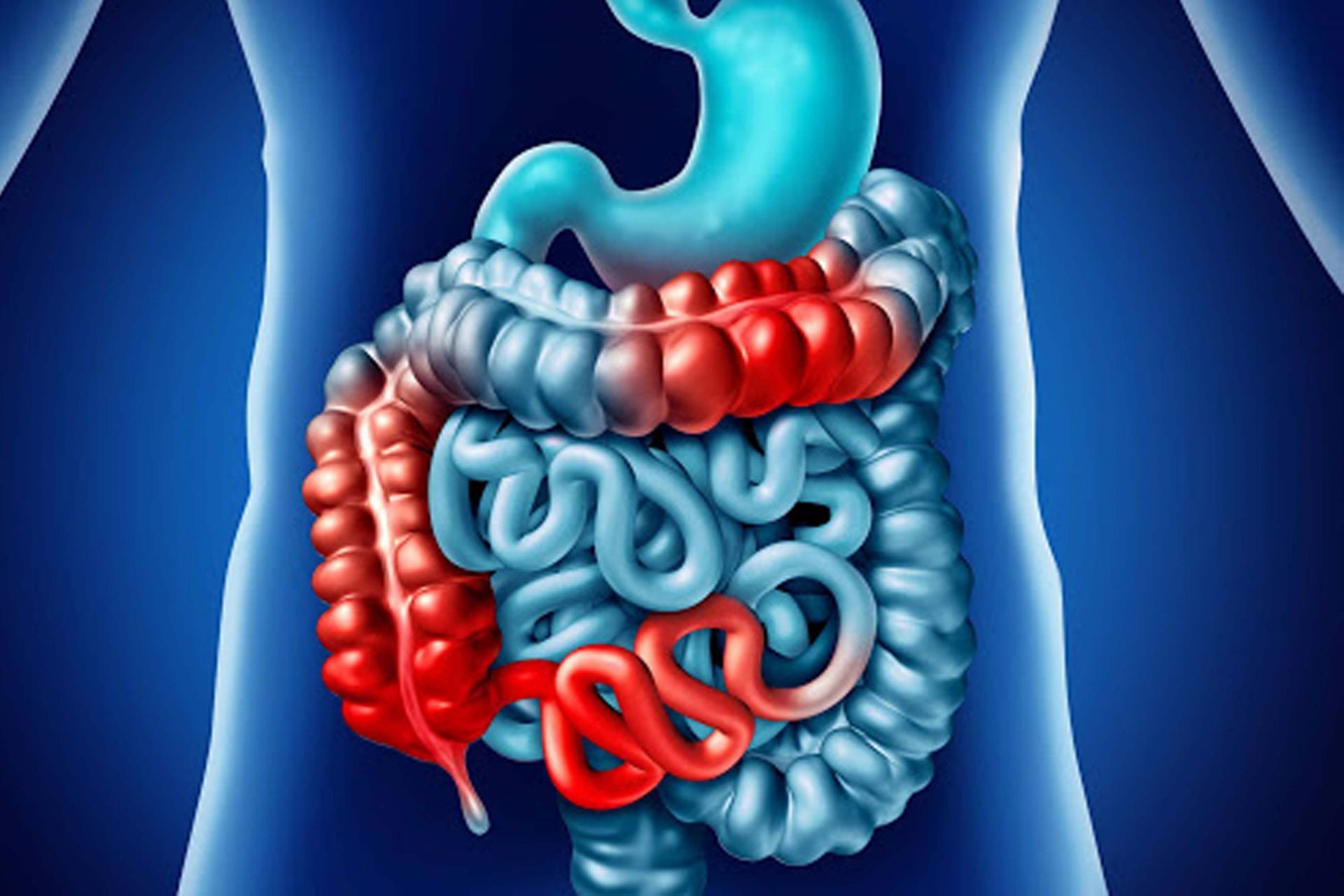 Inflammatory Bowel Disease (IBD) is a chronic condition that affects the gastrointestinal tract