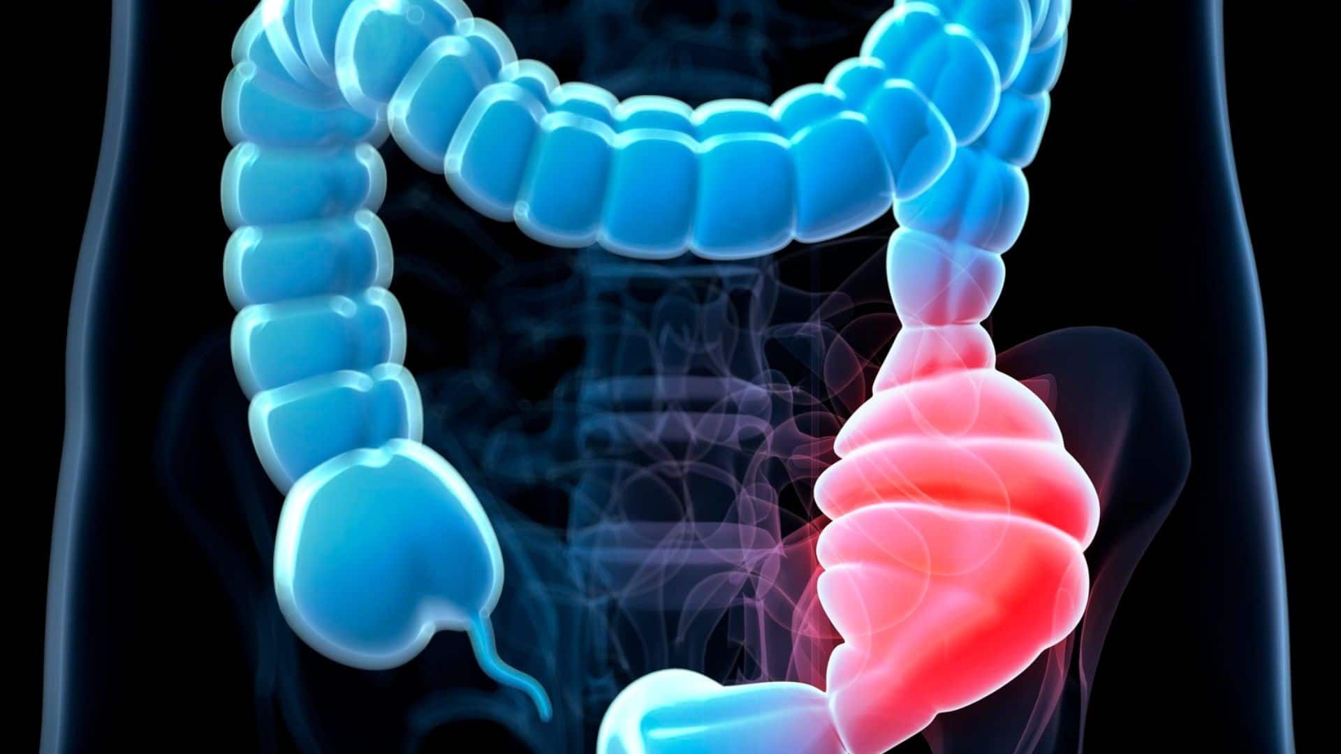 Irritable Bowel Syndrome (IBS) is a common gastrointestinal disorder that can significantly impact 