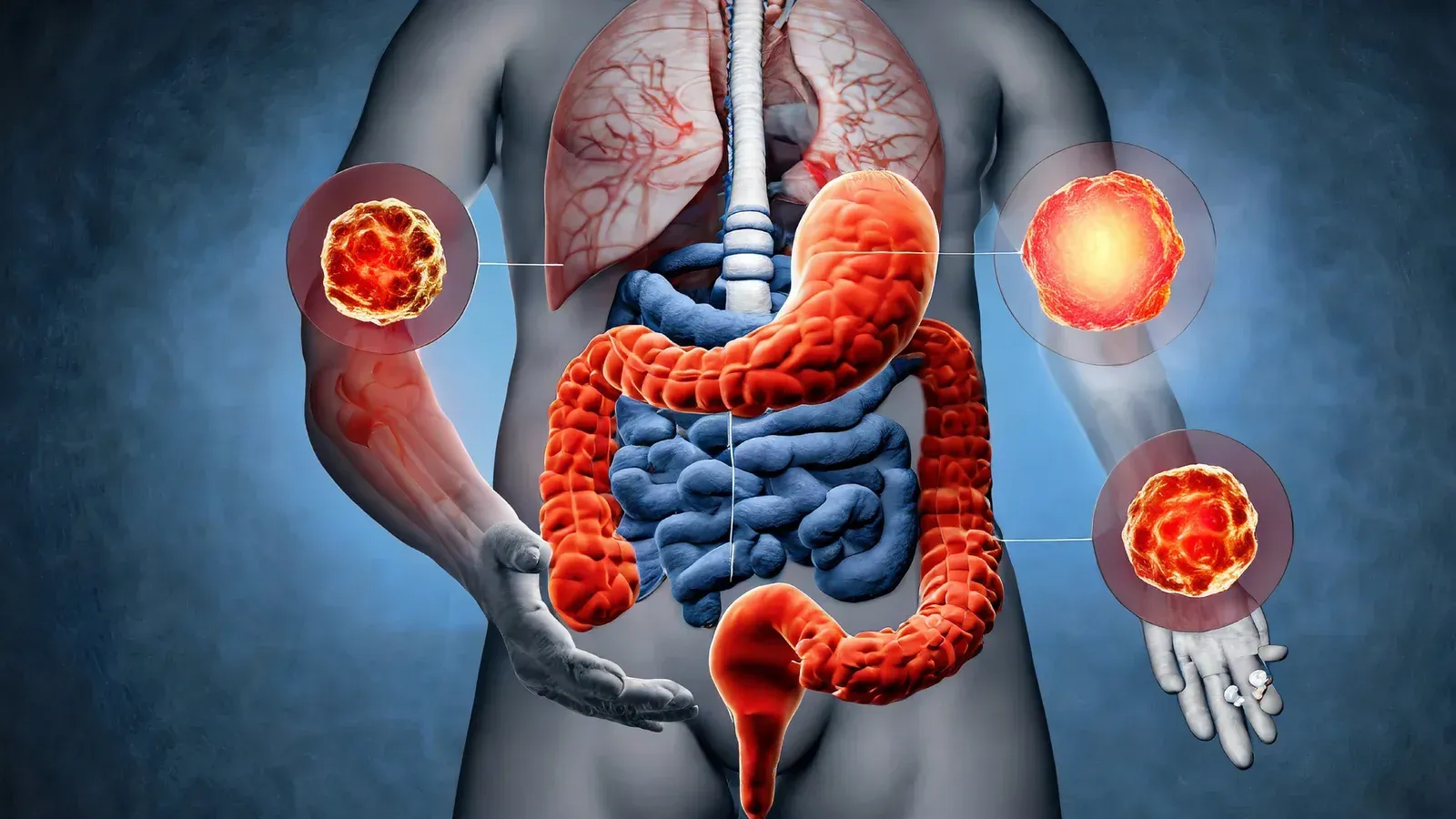Ulcerative colitis is a chronic inflammatory bowel disease that can lead to various complications