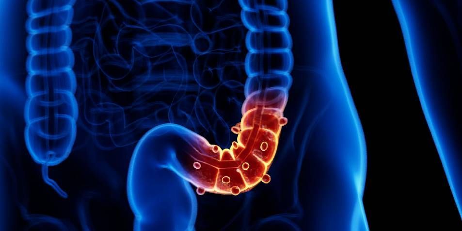 Constipation is a common gastrointestinal issue that can significantly impact