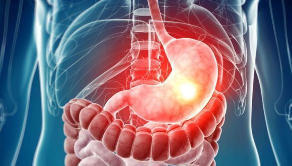 Gastroparesis is a gastrointestinal disorder that affects the normal movement of the stomach muscles