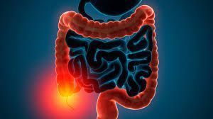 Ulcerative colitis is a chronic inflammatory bowel disease that affects the colon and rectum