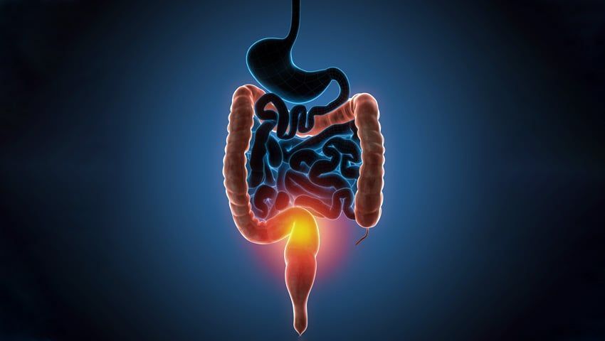 Diagnosing ulcerative colitis, a type of inflammatory bowel disease