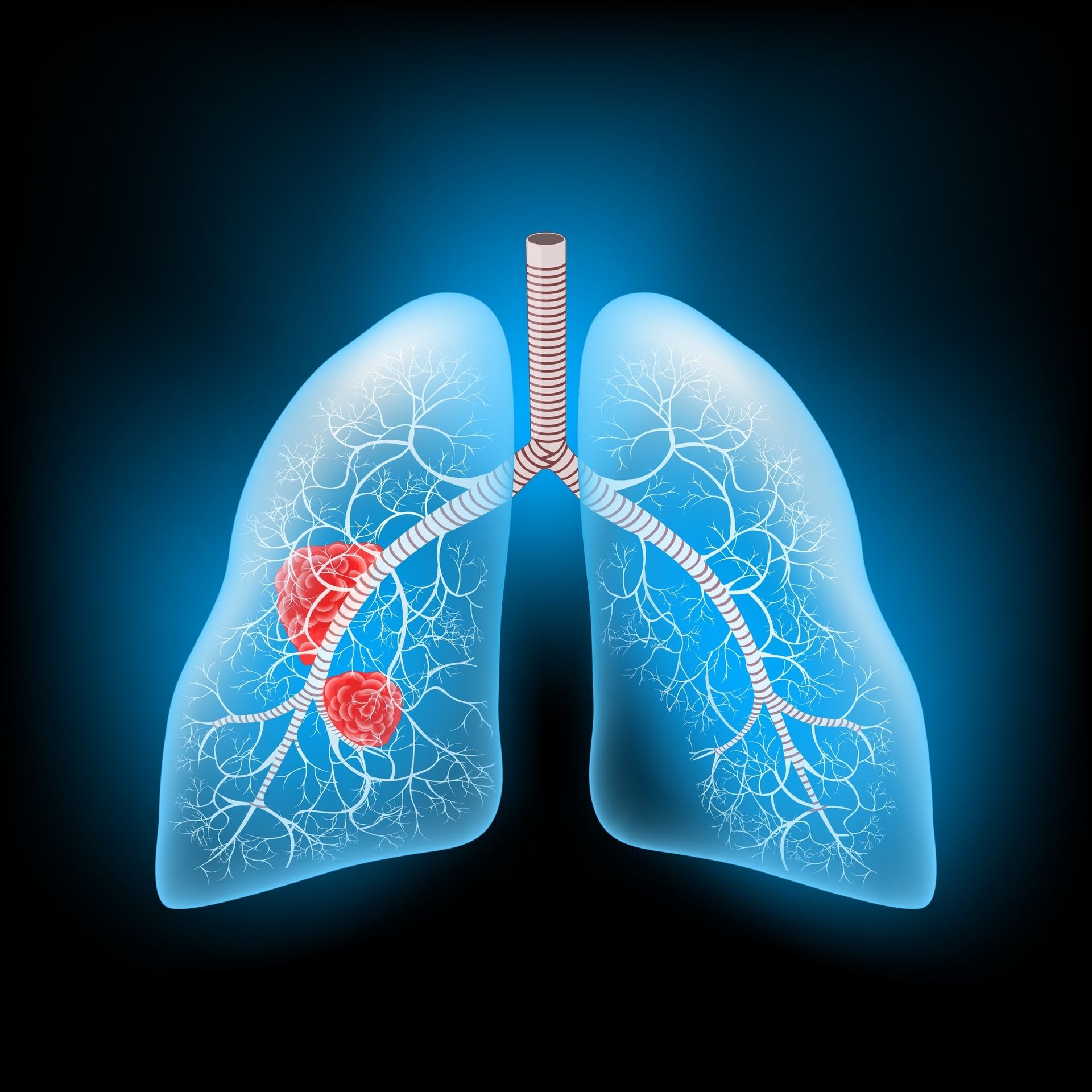 Screening+of+Colorectal+Cancer