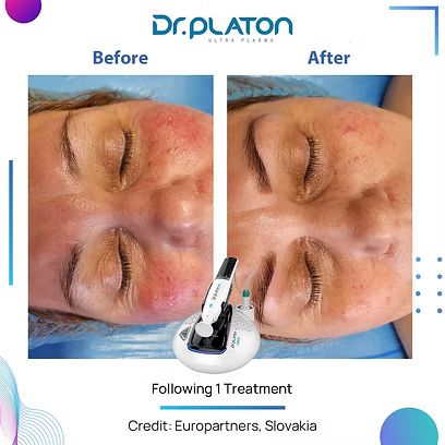 A woman 's face is shown before and after a treatment.