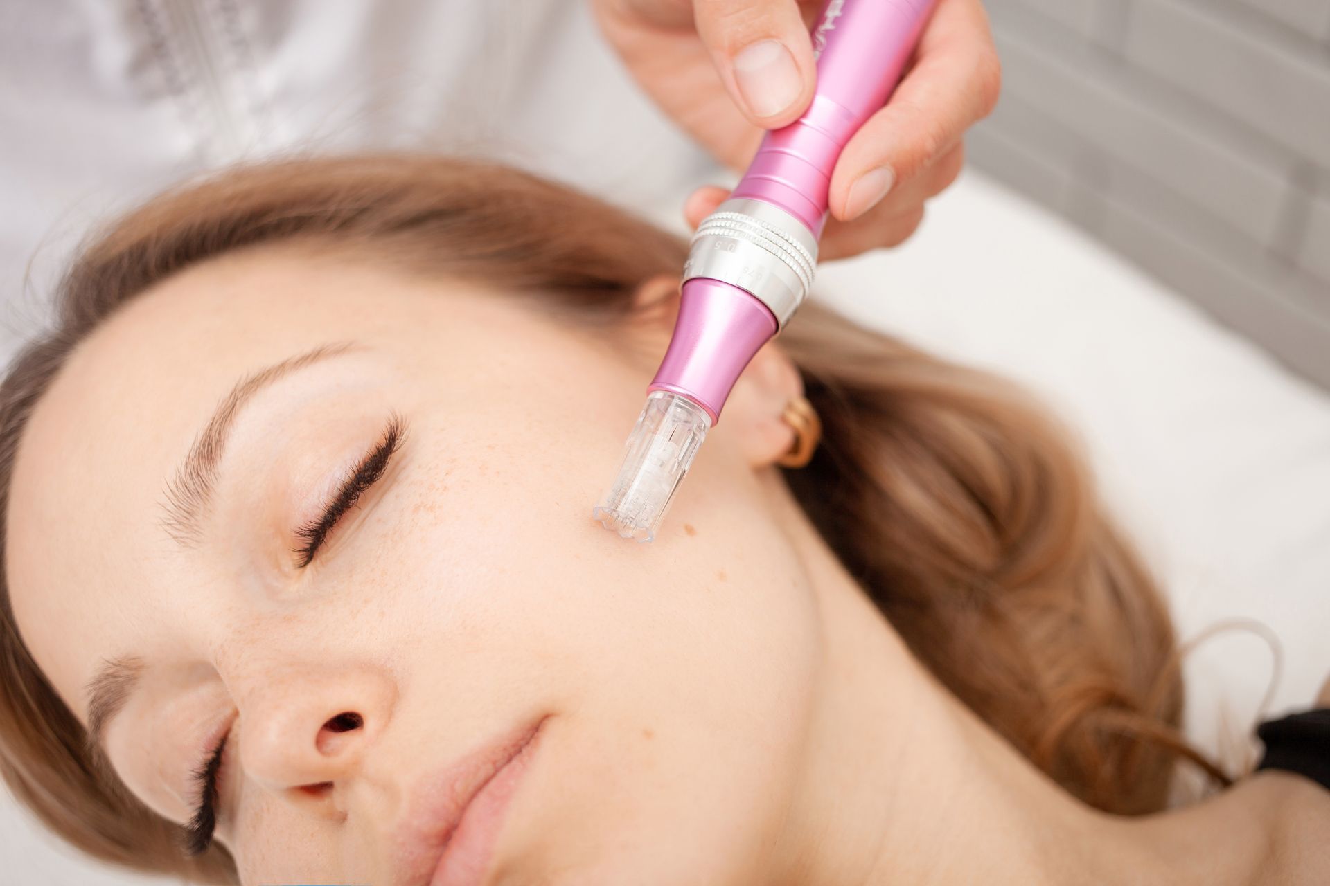 A hand uses a pink microneedling device on a person’s cheek during a cosmetic skin treatment.