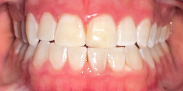 Close-up of a person's teeth, showing the upper and lower teeth with some discoloration and white spots.