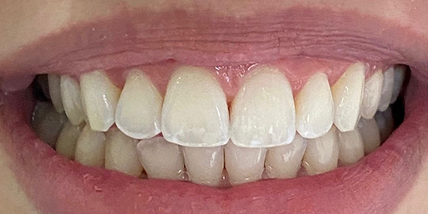 Close-up of teeth with a bump on one. The gum is visible and pink. The teeth are yellowish.