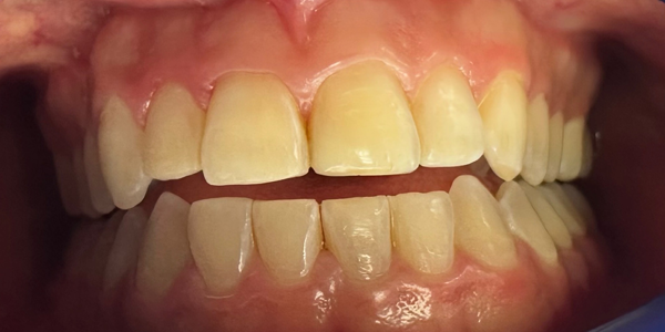 Close-up of a person's teeth, showing visible white spots and the texture of the teeth and gums.