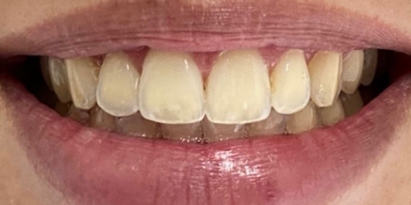 Close-up of teeth; one tooth has a brown cavity in it.