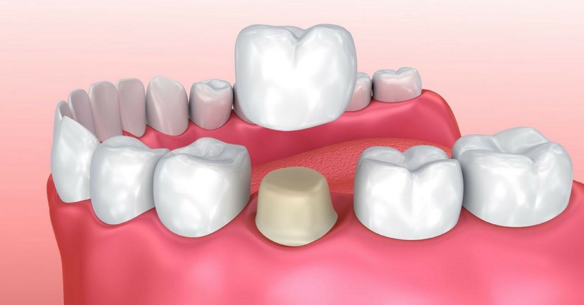 Dental crown on a tooth, surrounded by other teeth in a mouth. Beige and white colors.