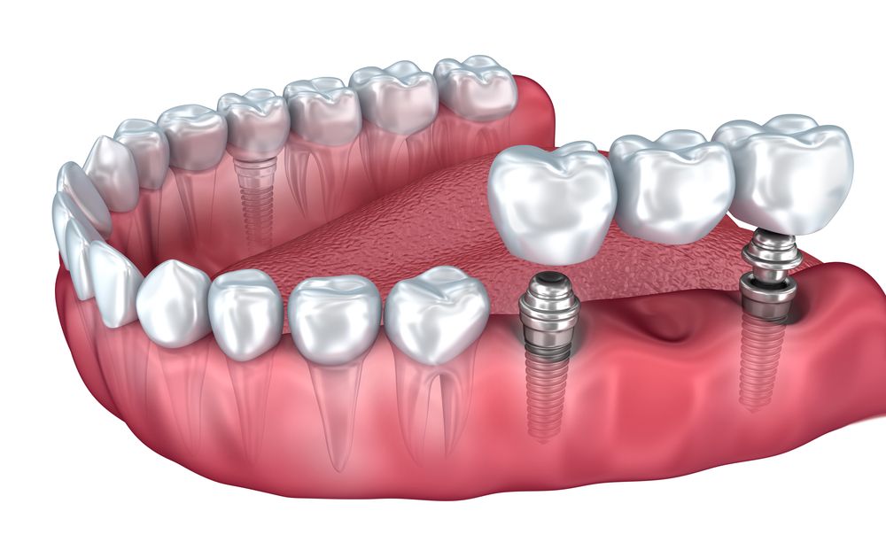 Dental implant with a bridge, showing teeth and gums in a mouth.