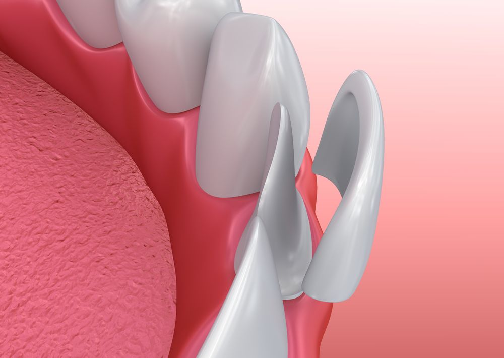 Dental veneers being placed on teeth; pink gums, white veneers, and a red background.