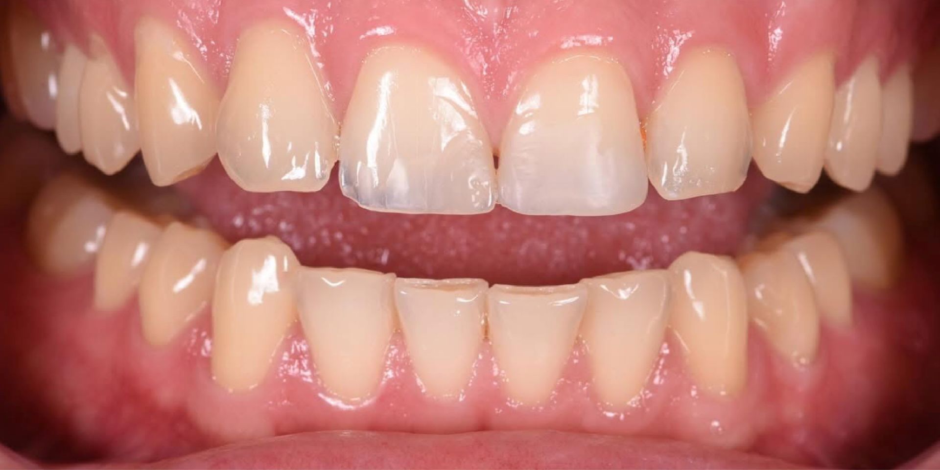 Close-up of teeth; one tooth has a brown cavity in it.