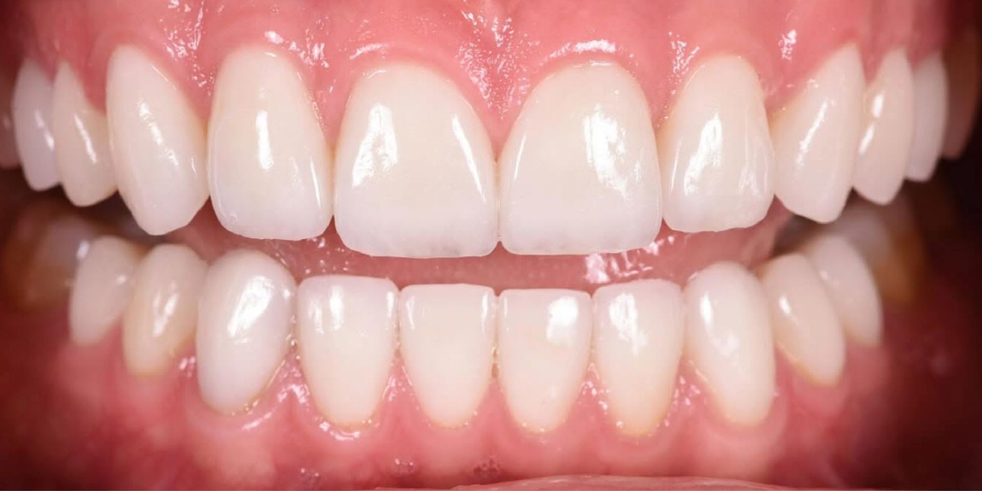 Close-up of teeth with a bump on one. The gum is visible and pink. The teeth are yellowish.