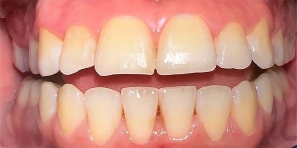 Close-up of human teeth, showing the upper and lower rows, slightly yellowed with a visible gum line.