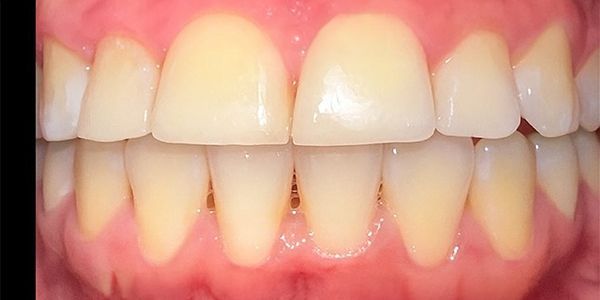 Close-up view of teeth and gums, light yellow teeth, pink gums.