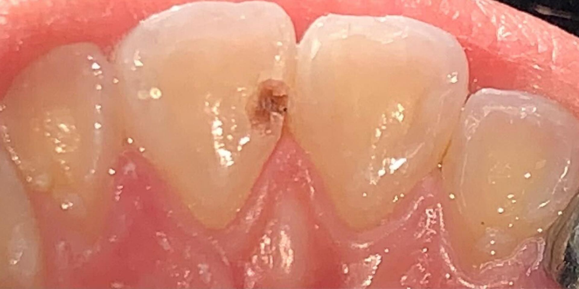 Close-up of teeth; one tooth has a brown cavity in it.