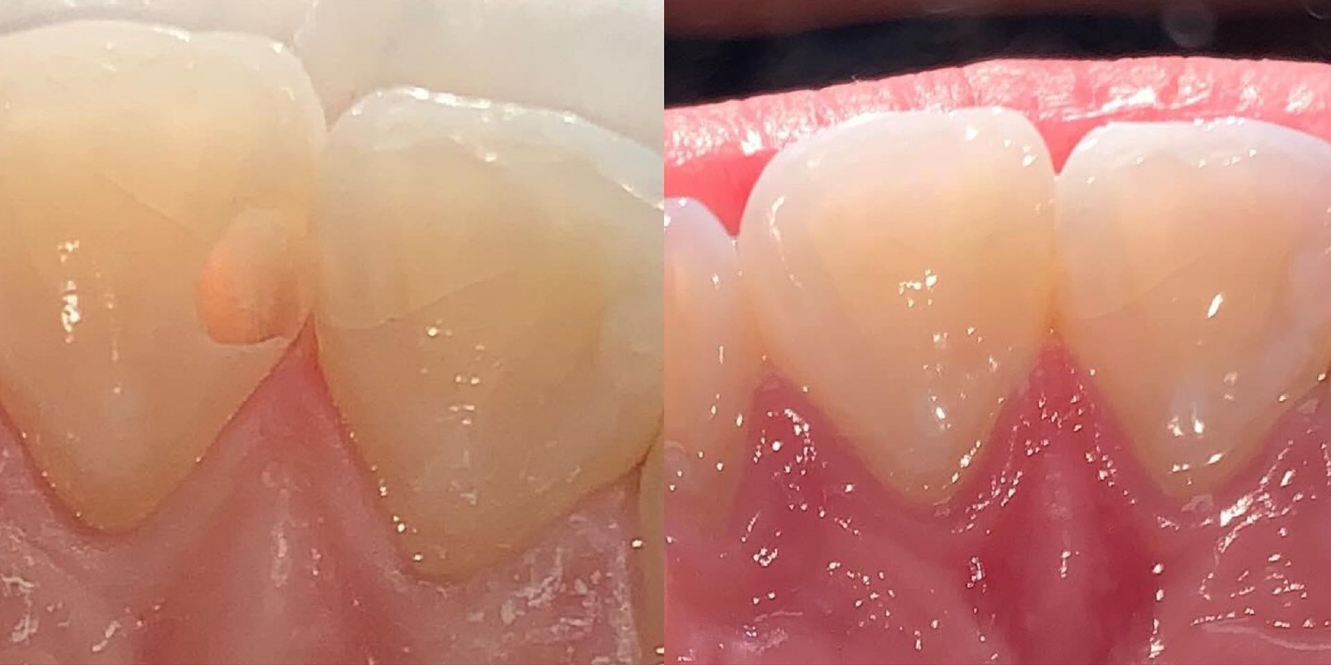 Close-up of teeth with a bump on one. The gum is visible and pink. The teeth are yellowish.