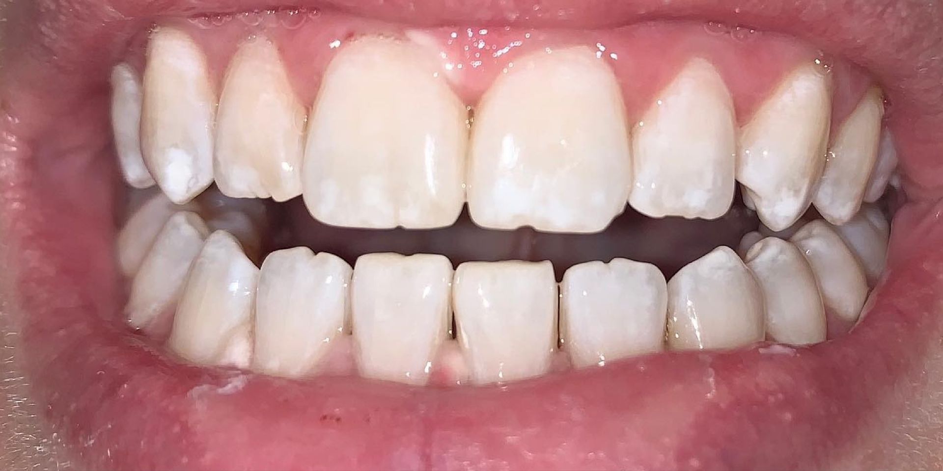 Close-up of a person's teeth, showing visible white spots and the texture of the teeth and gums.
