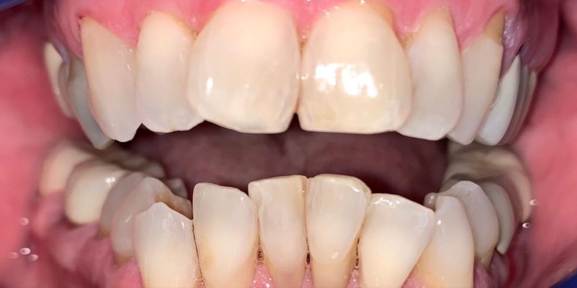 Close-up of human teeth, showing a slightly imperfect smile with visible upper and lower teeth.