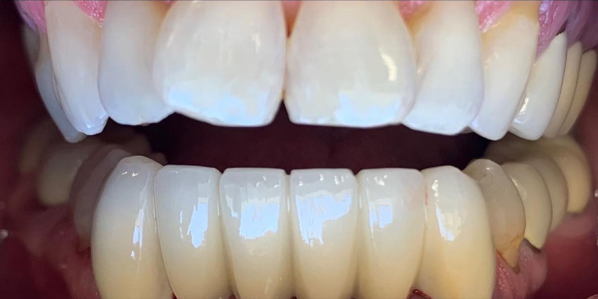 Close-up of a person's teeth, showing upper and lower sets. The teeth are white and straight.