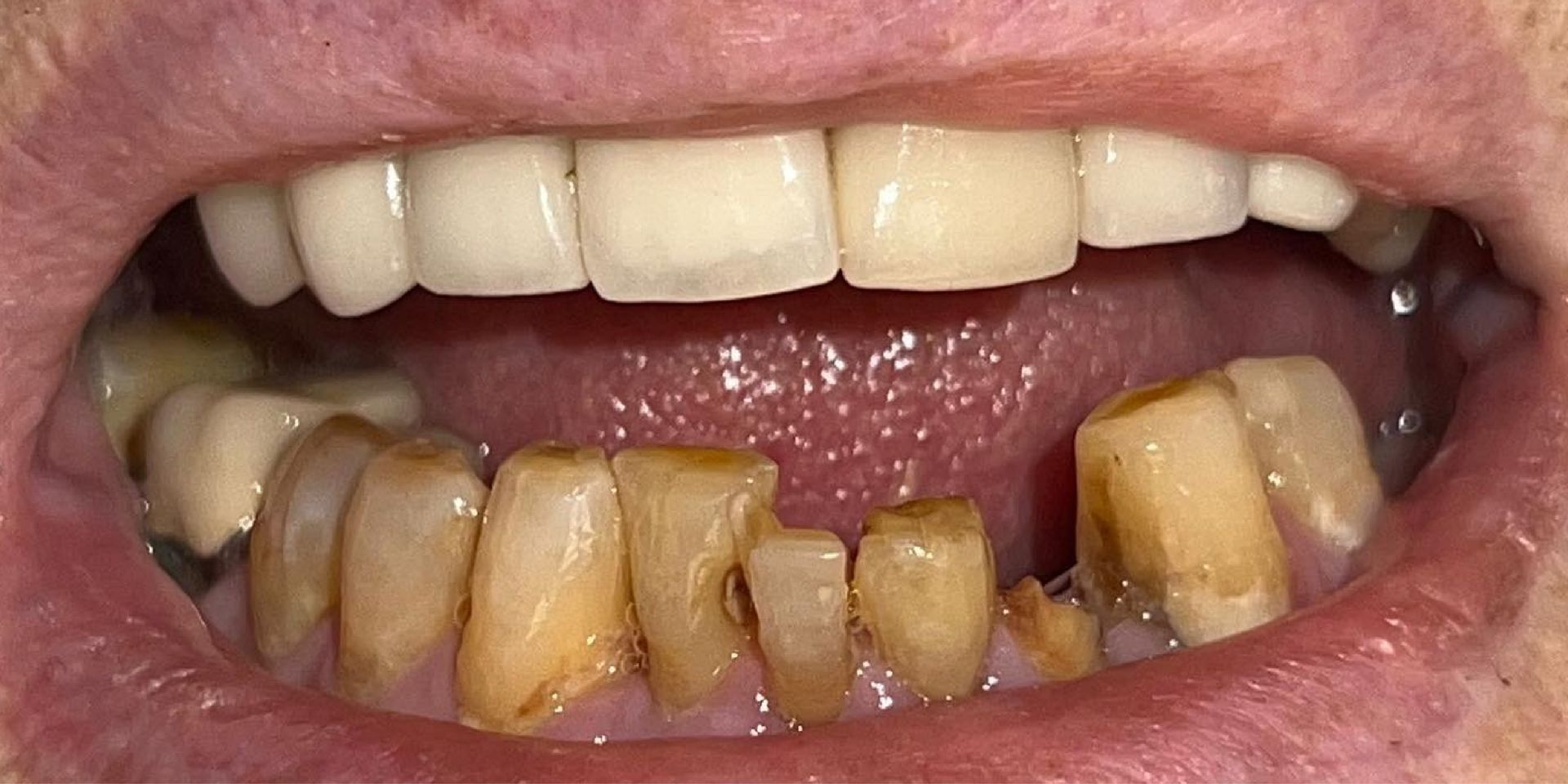 Close-up of mouth showing top row of white teeth and bottom row of severely damaged yellow teeth.