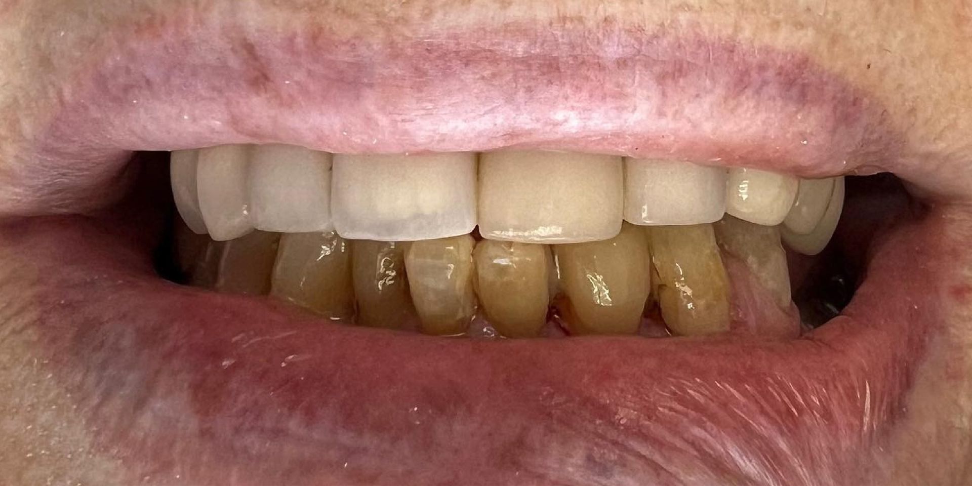 Close-up of a person's mouth, showing teeth with visible discoloration and pink lips.