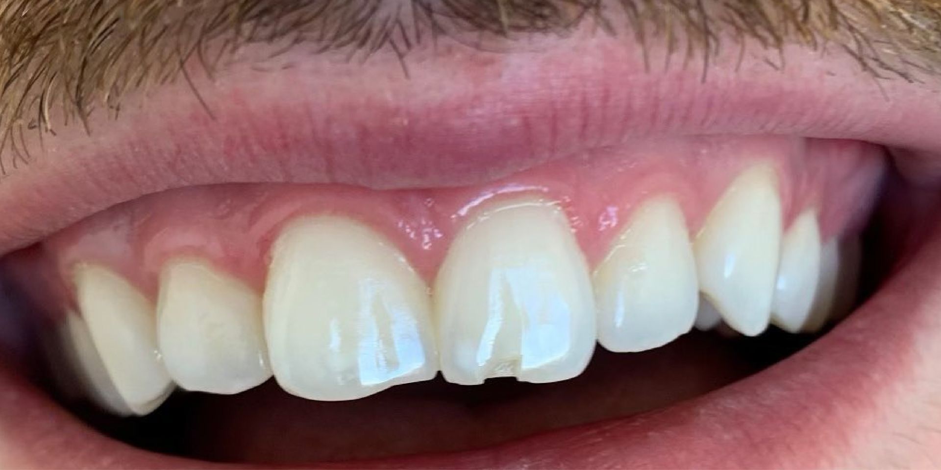 Close-up of a person's teeth, showing white teeth with pink gums, and a slightly open mouth.