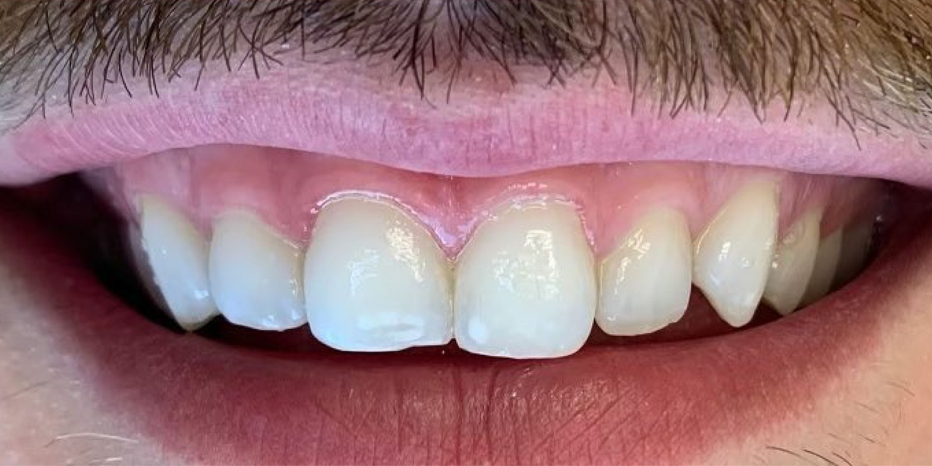 Close-up of person's mouth with teeth. Two central incisors are prominent. Dark mustache above.