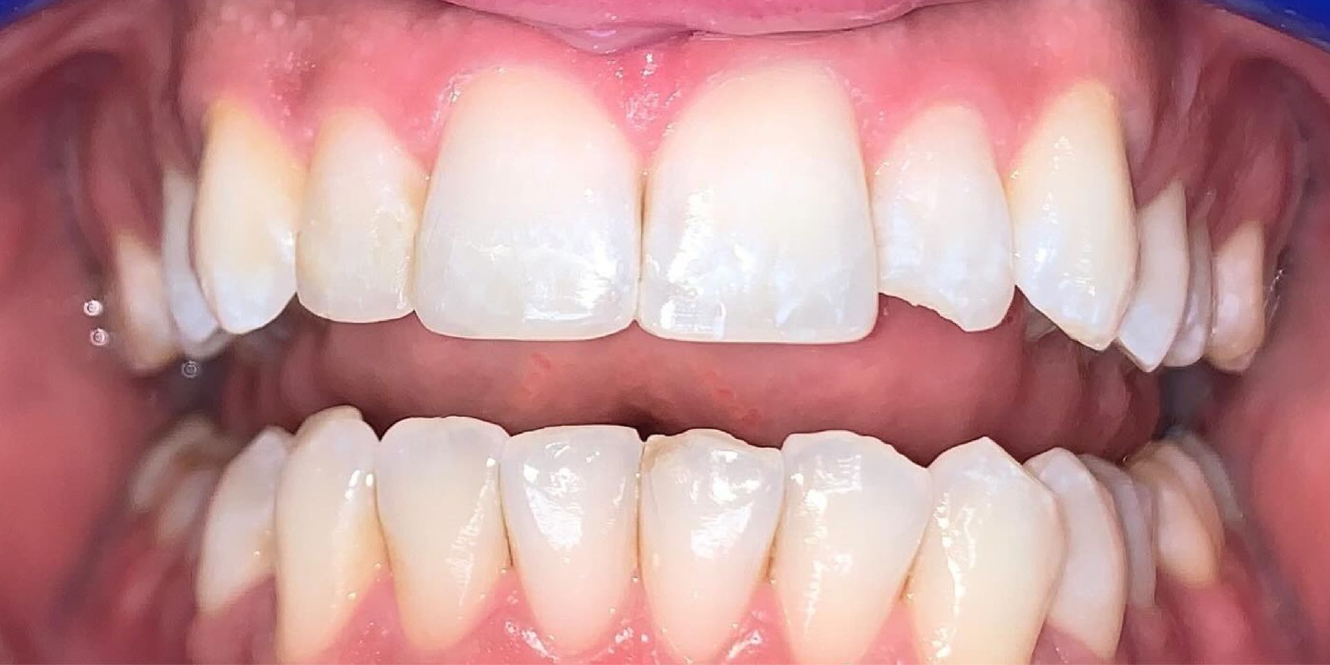 Close-up view of a person's teeth, showcasing healthy, bright white upper and lower teeth.