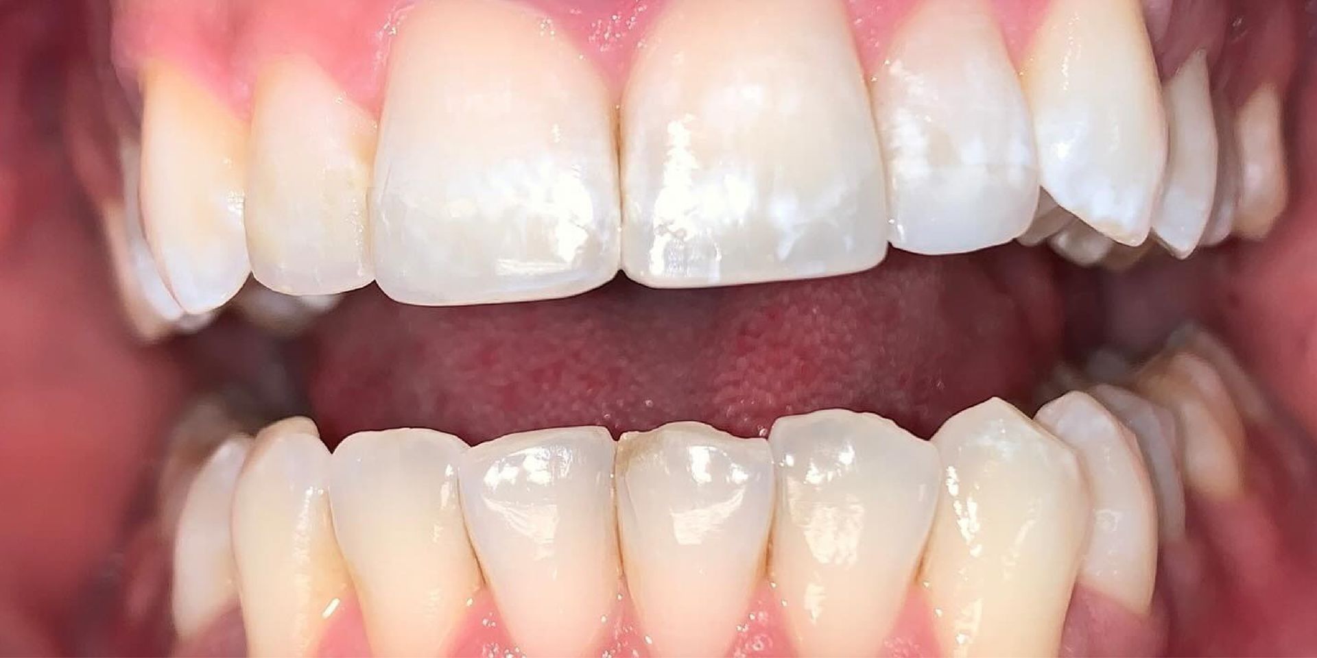 Close-up of a mouth with bright white teeth, open and slightly angled, with tongue visible.