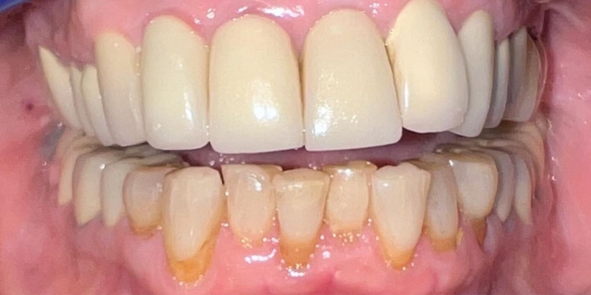 Close-up of teeth, upper teeth are white and healthy, lower teeth are yellowed.