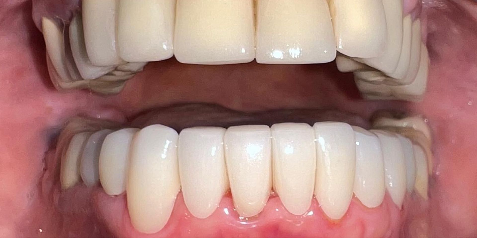 Close-up of human teeth with a clear retainer on the top teeth.