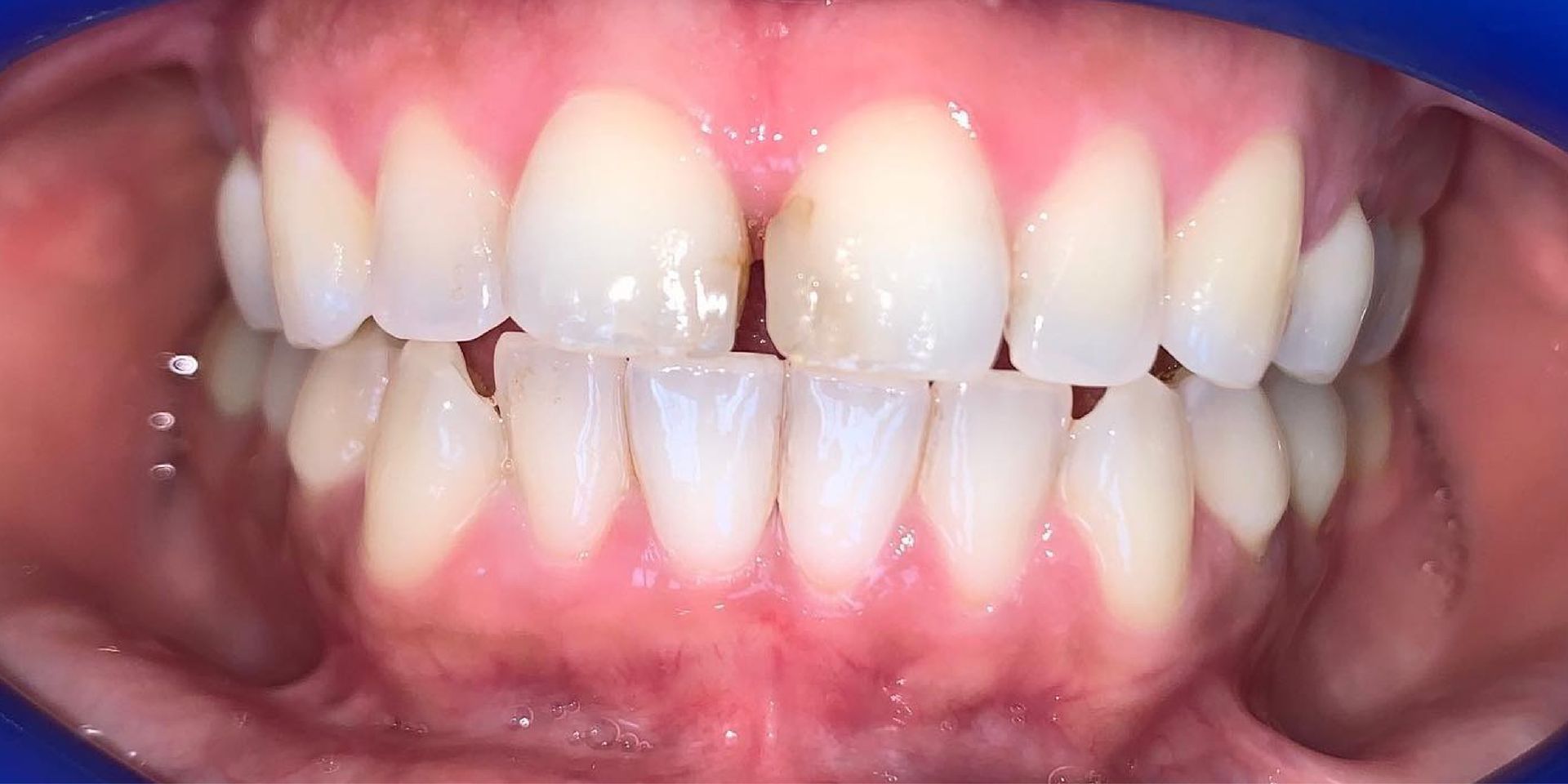 Close-up of human teeth showing a diastema between two front teeth. Pink gums and white teeth are visible.