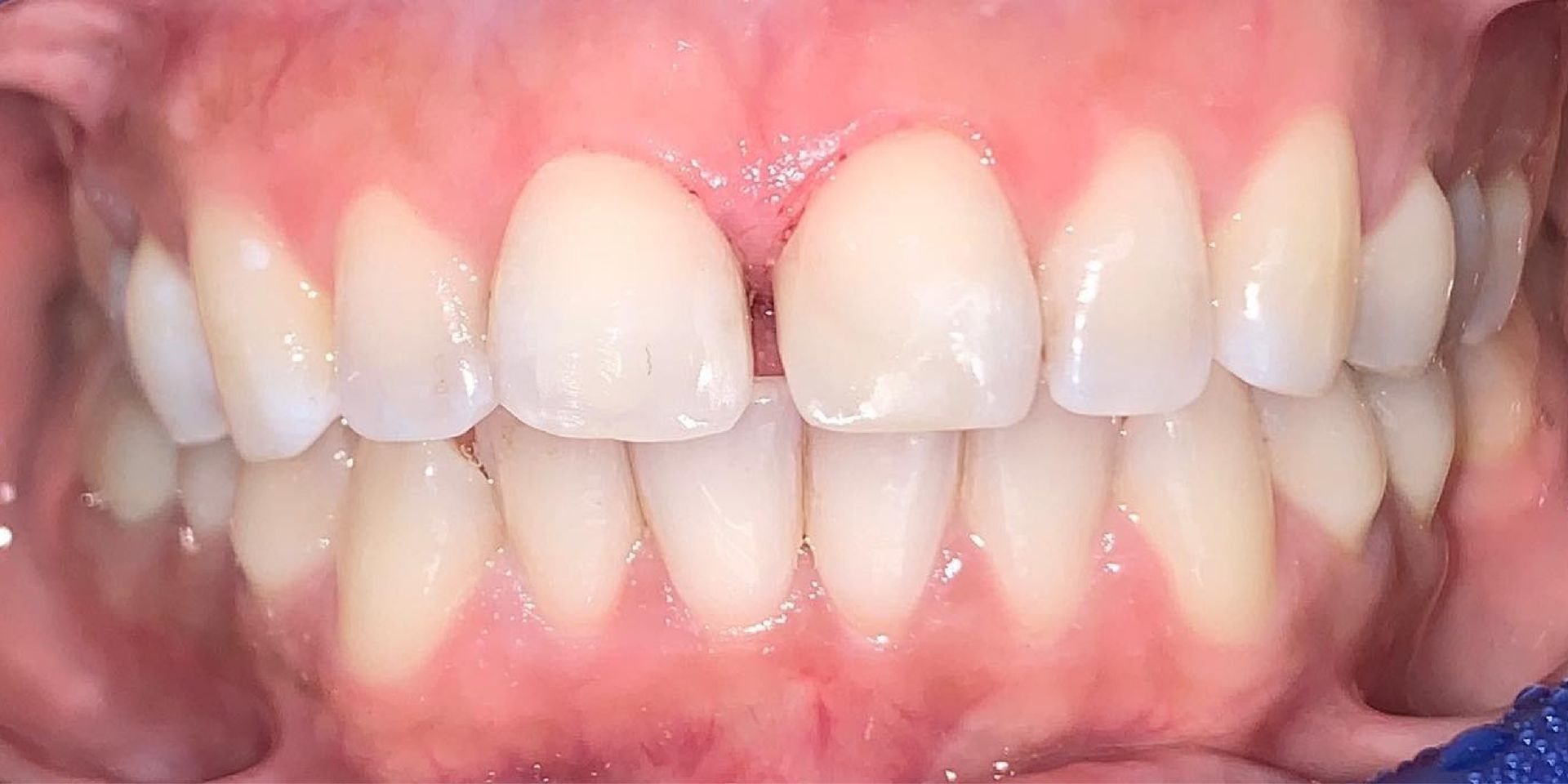 Close-up of human teeth showing the upper and lower rows, with a gap between the two front teeth.