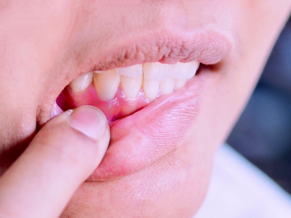 Finger pointing at inflamed, red gums in close-up, inside the mouth.