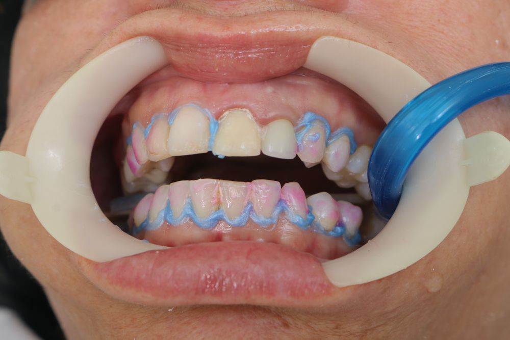 Mouth open with teeth marked in blue/pink for dental work, wearing a cheek retractor.