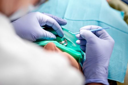 Dentist working on patient's teeth, using tools, wearing gloves, surrounded by a blue dental dam.