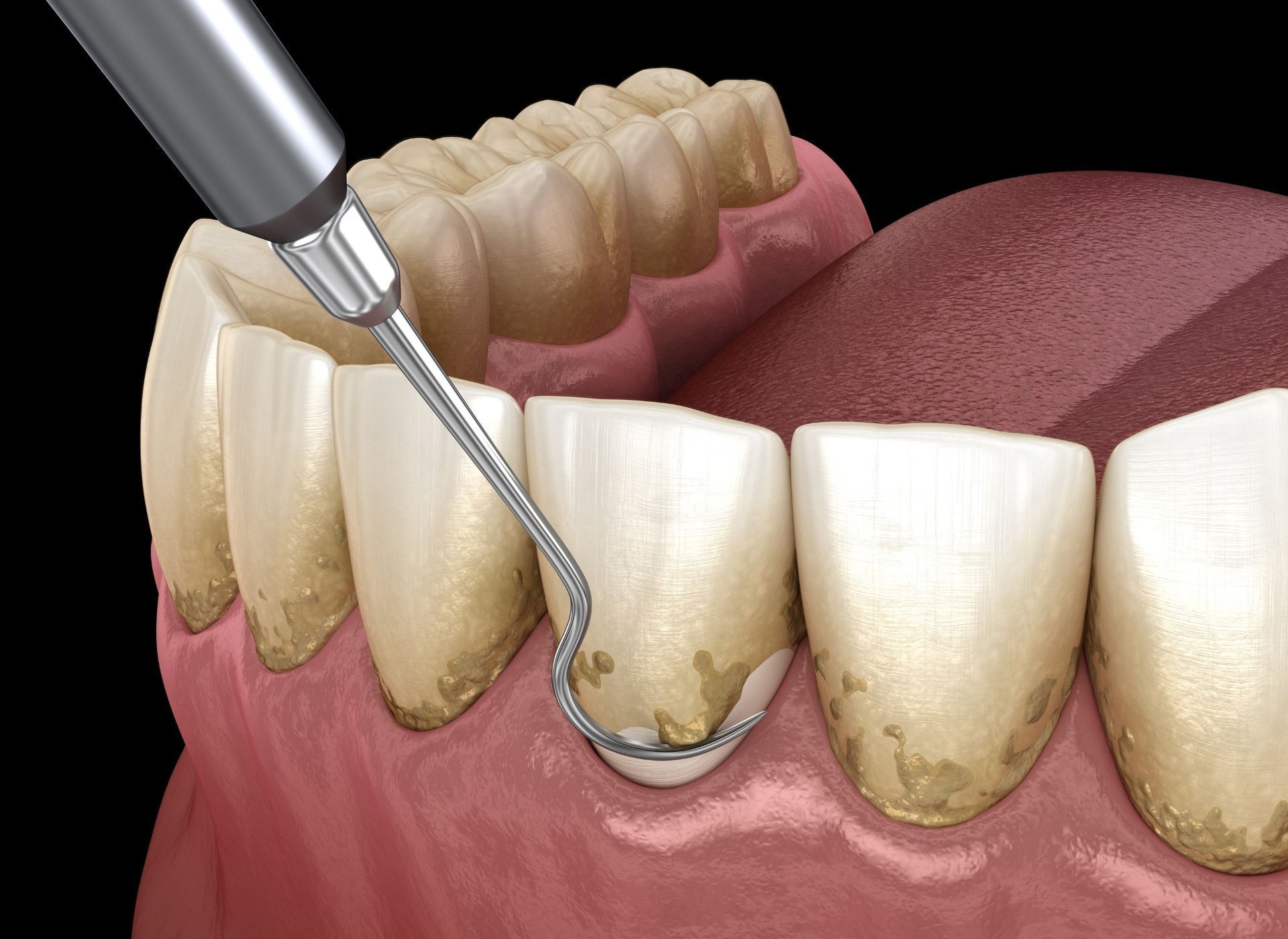 Dental hygienist cleaning teeth with a scaling tool, removing plaque and tartar.
