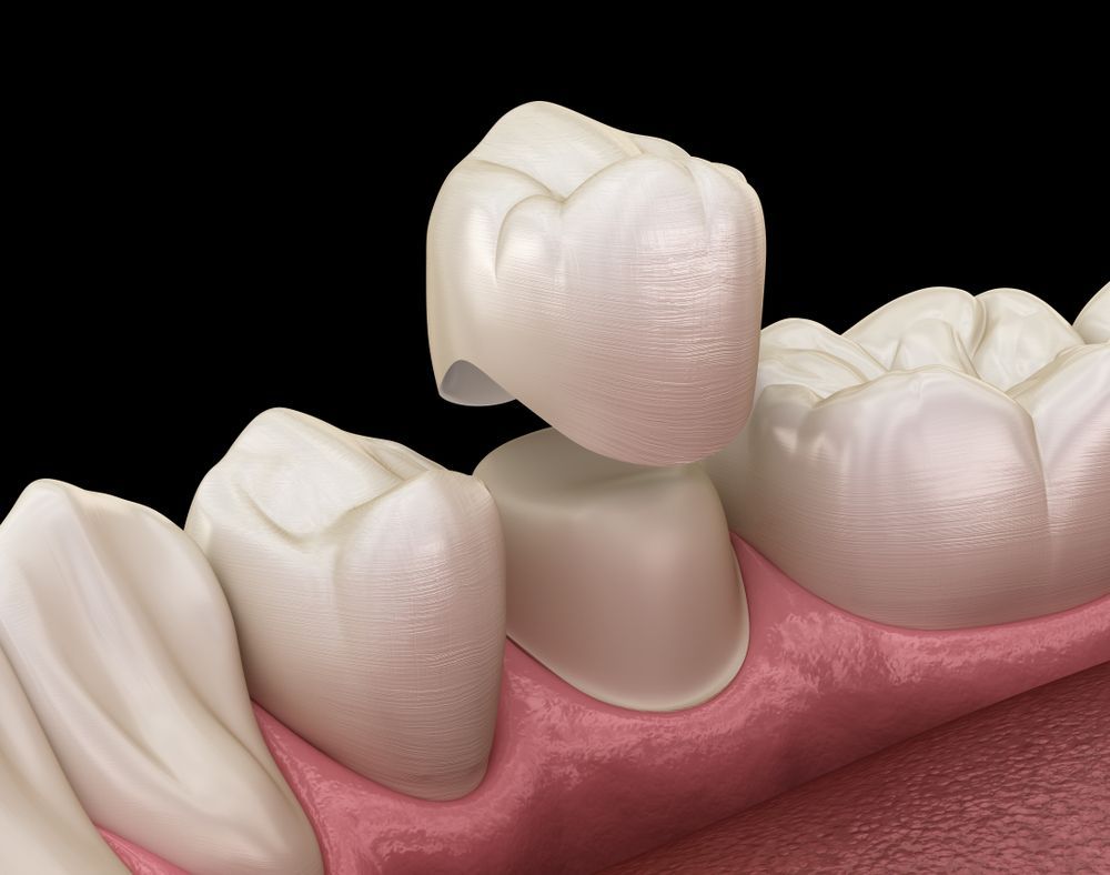Dental crown being placed on a prepared tooth. White crown, pink gums, dark background.