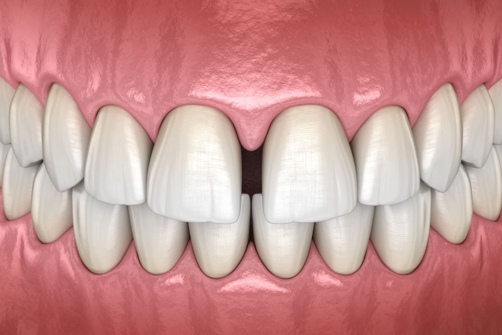 Close-up of teeth with a gap between the front teeth, showing the upper and lower arches.