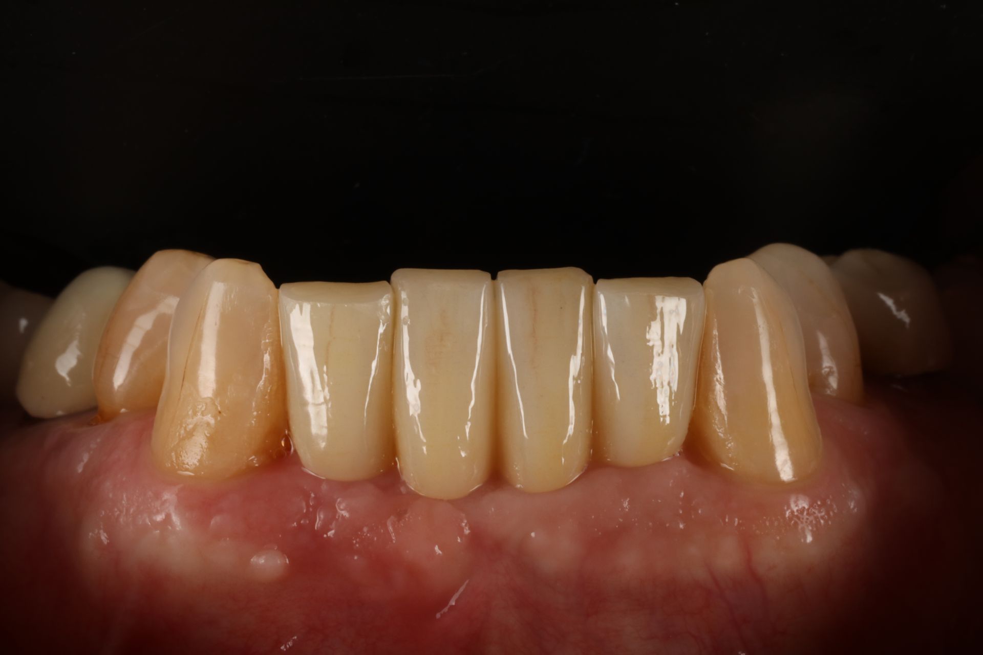 Close-up of teeth, likely dental work. Light yellow-white color, with pink gums. Black background.
