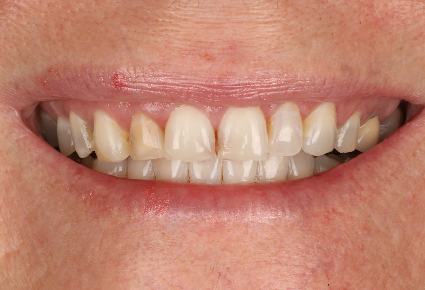Close-up of a smiling mouth, showing teeth with slight yellowing and visible gums.