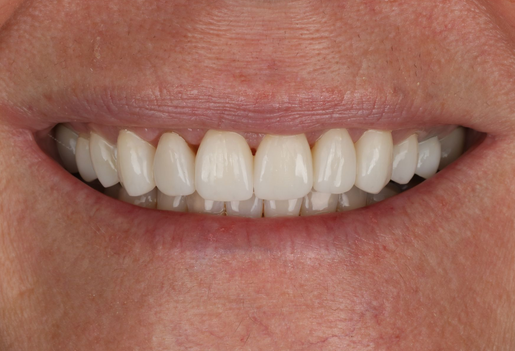 Close-up of a smiling mouth, showing bright white teeth with slight imperfections.