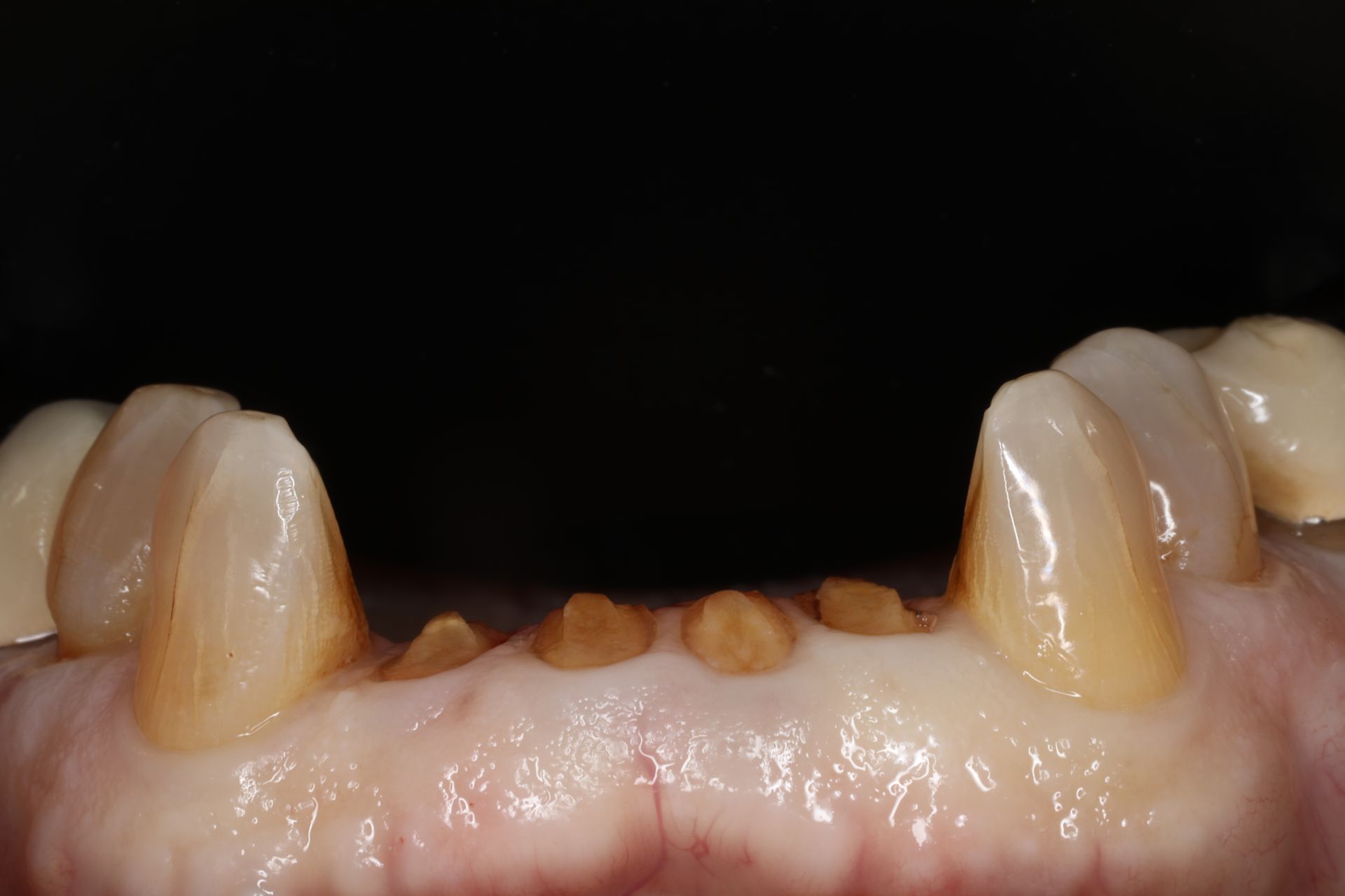 Close-up of lower teeth. Several small, brown pegs are visible between the front teeth.